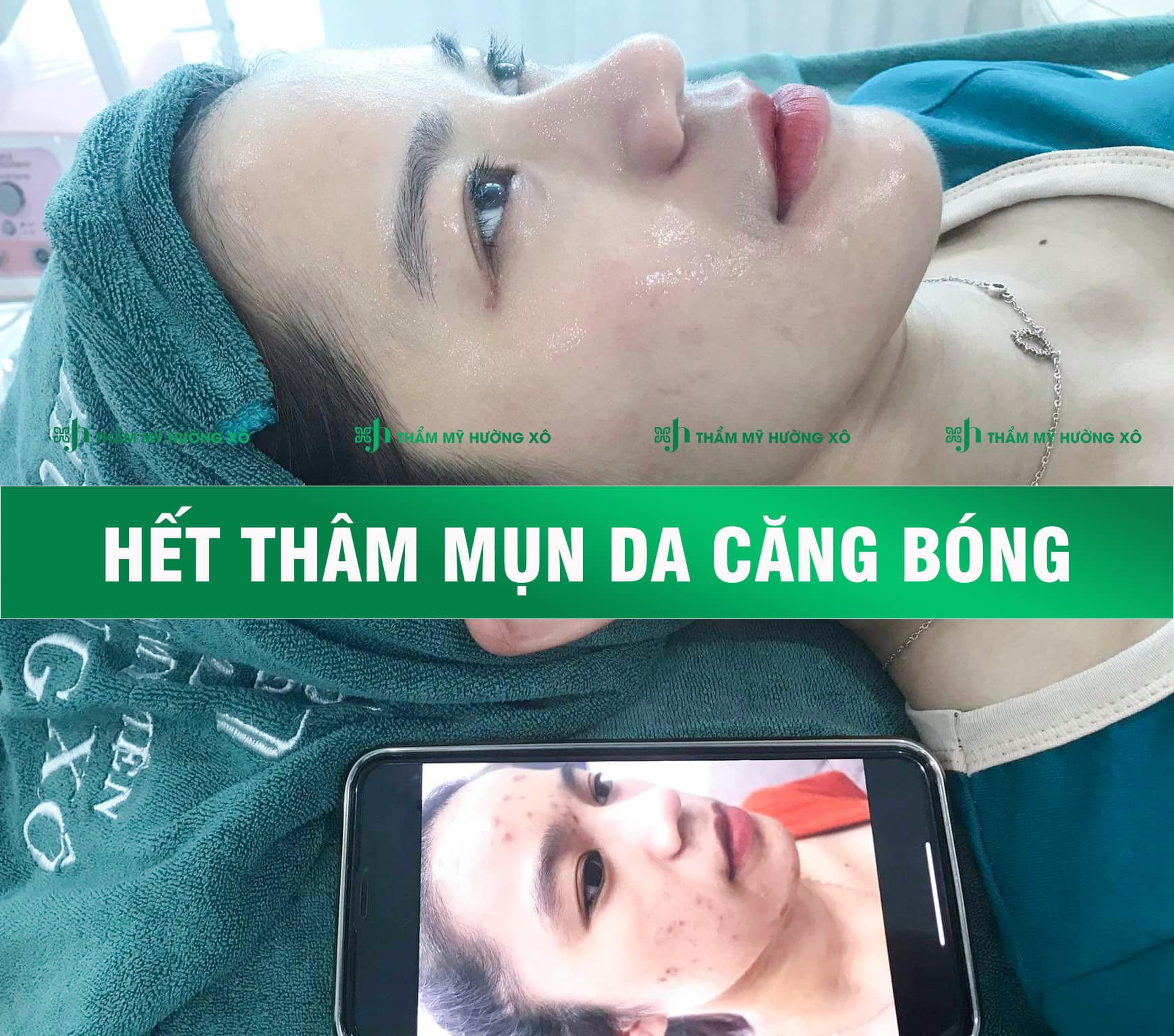 Điều trị thâm mụn hiệu quả tại Hà Tĩnh