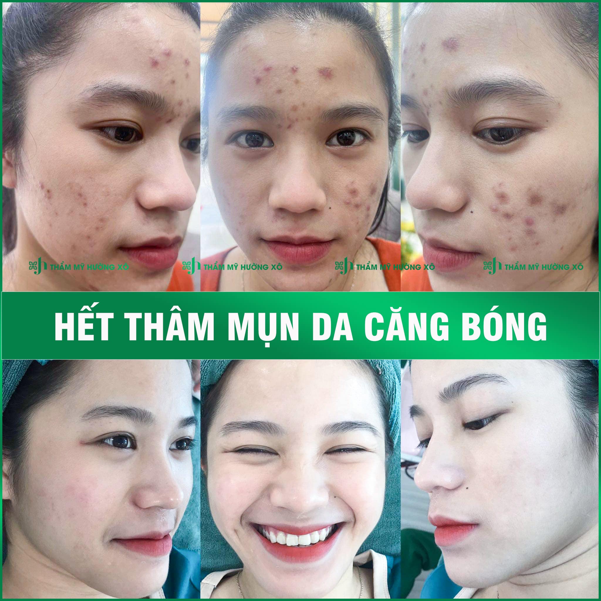 Điều trị thâm mụn hiệu quả tại Hà Tĩnh