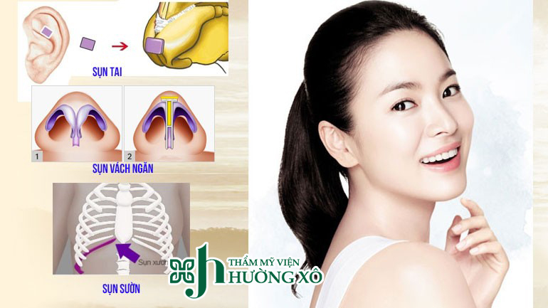 Nâng mũi cấu trúc tại Vinh