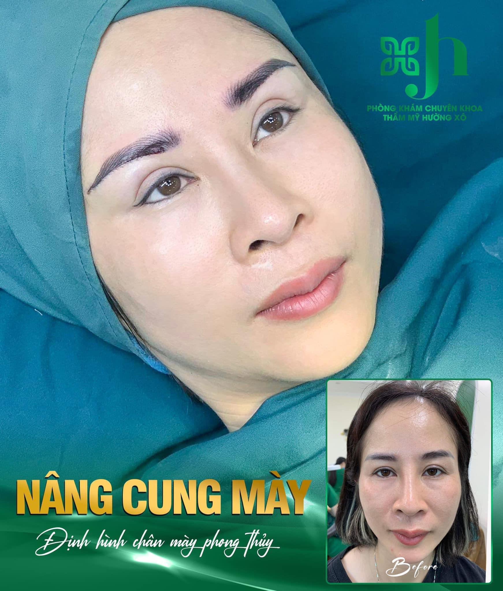 Nâng cung chân mày uy tín tại Hà Tĩnh