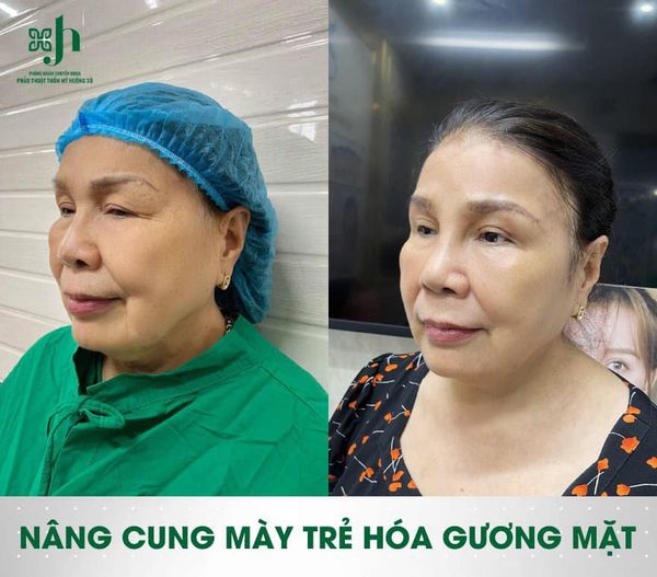 Nâng cung chân mày uy tín tại Hà Tĩnh