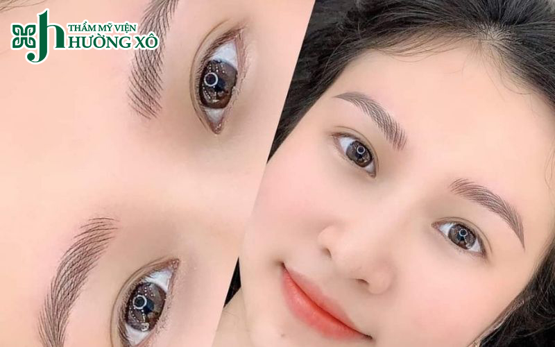 cắt mí mắt tại Hà Tĩnh