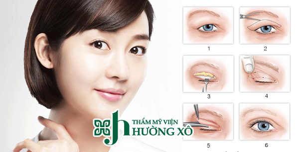 Cắt mí mắt tại Hà Tĩnh