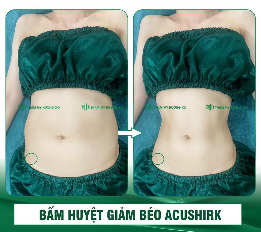 Bấm huyệt giảm béo tại VInh