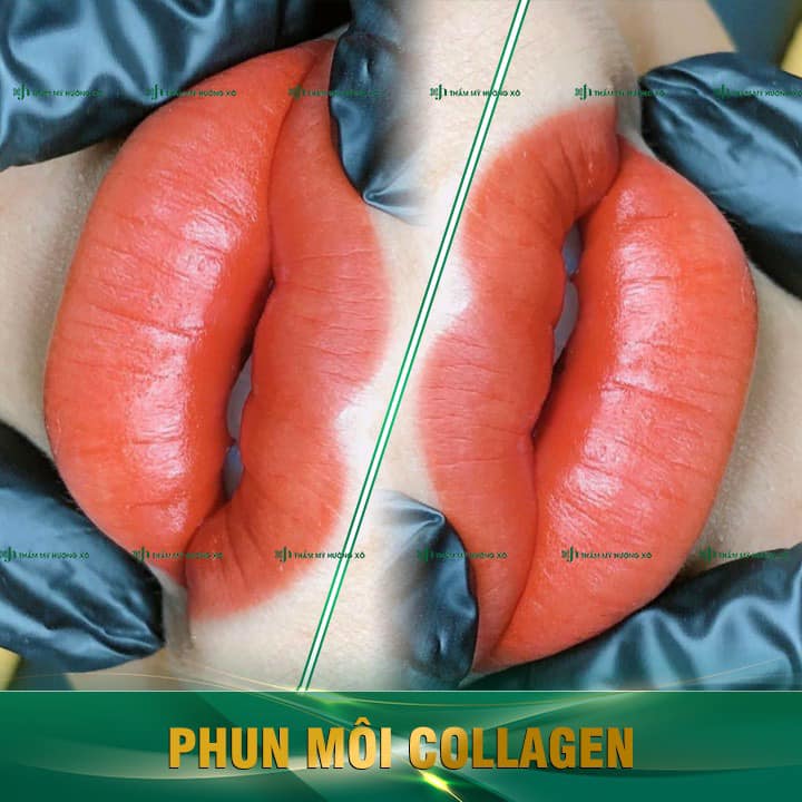 Phun môi Collagen tại Vinh