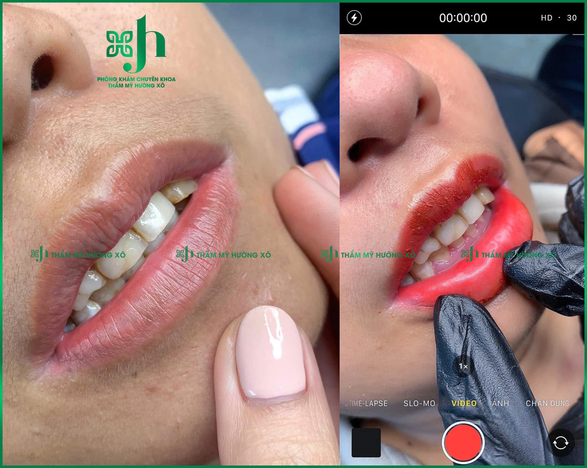 Phun môi Collagen tại Vinh