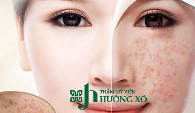Điều trị nám tại Vinh