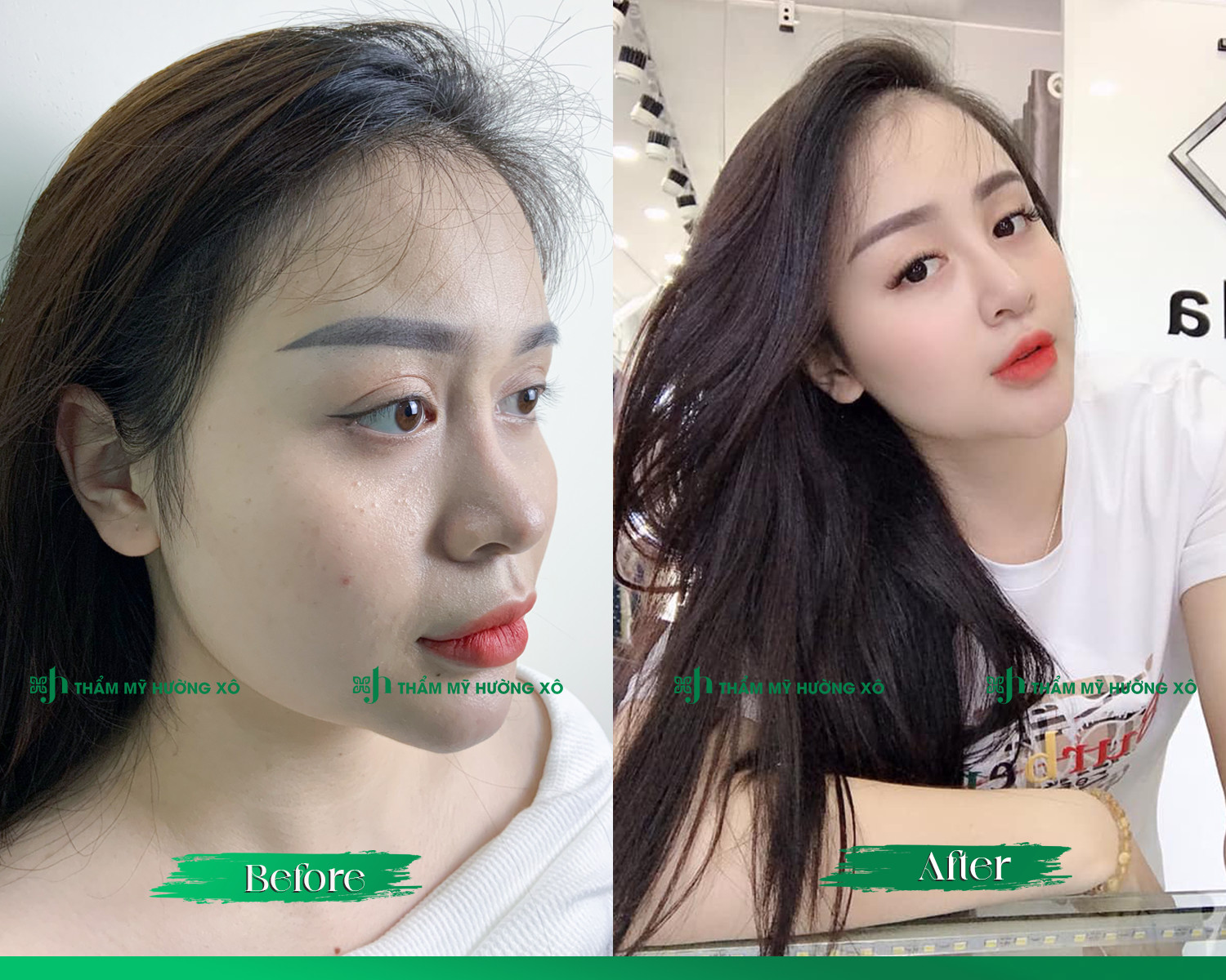 Dịch vụ nâng mũi uy tín tại Vinh