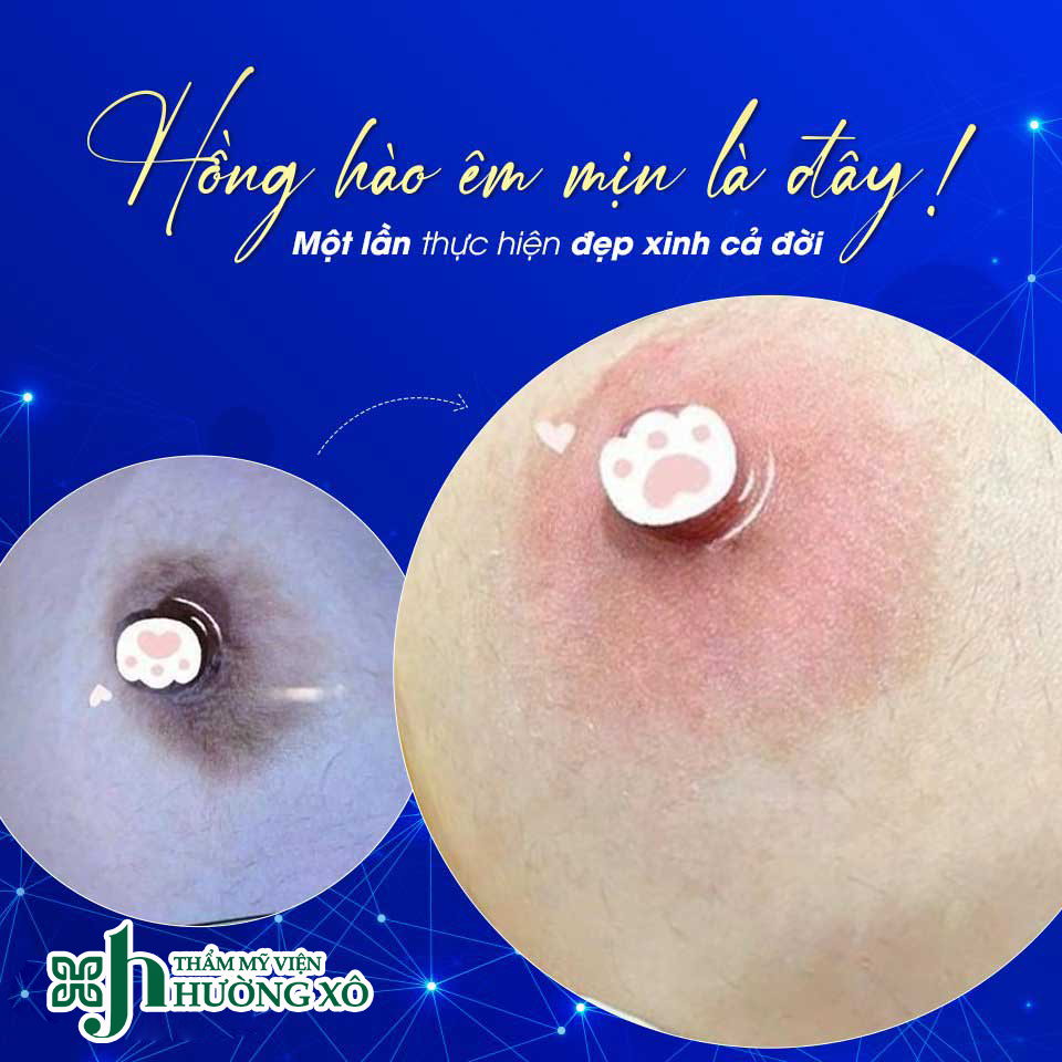 Làm hồng nhũ hoa uy tín tại Vinh, Nghệ An