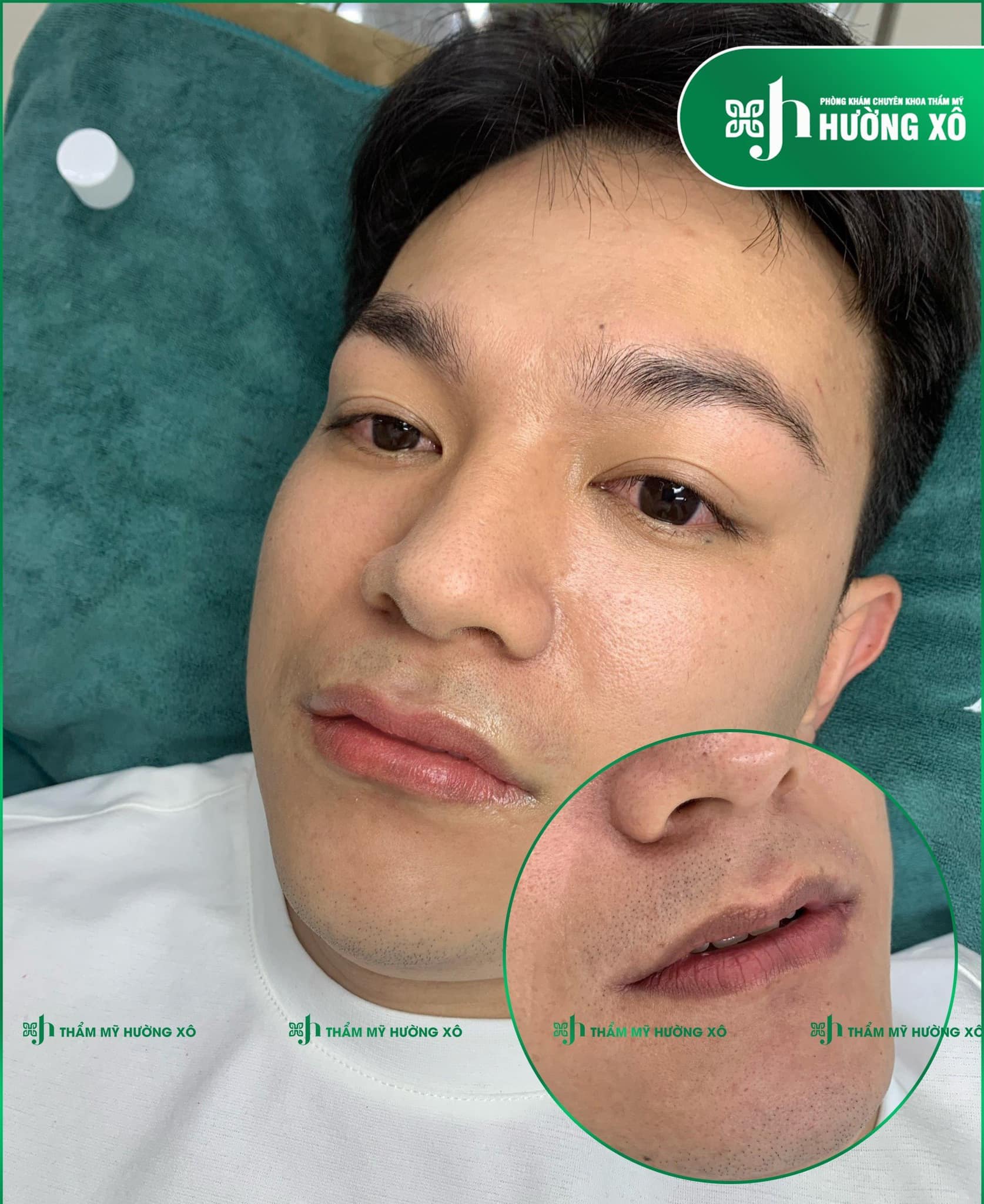 Khử thâm môi tại Vinh