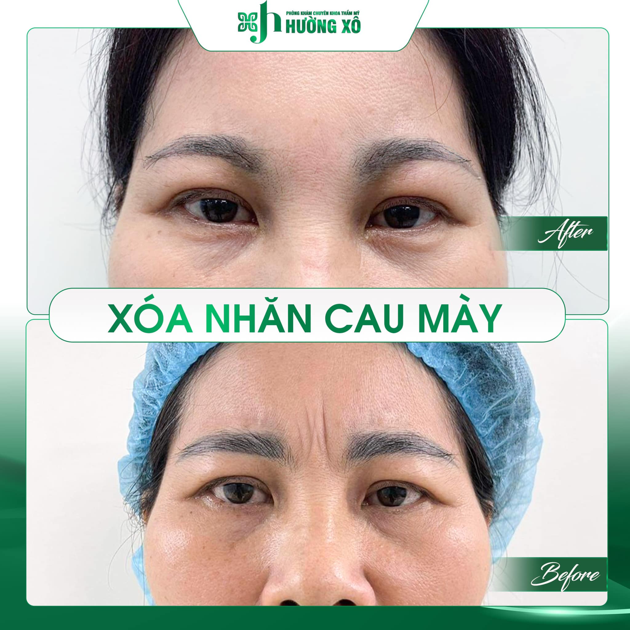 Xóa nhăn cau mày uy tín tại Hà Tĩnh