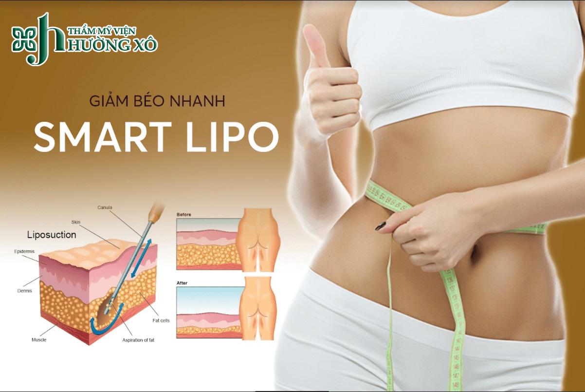 Dịch vụ Giảm Béo Smart Lipo Tại Vinh