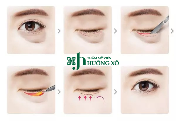 Lấy mỡ bọng mắt uy tín tại Vinh