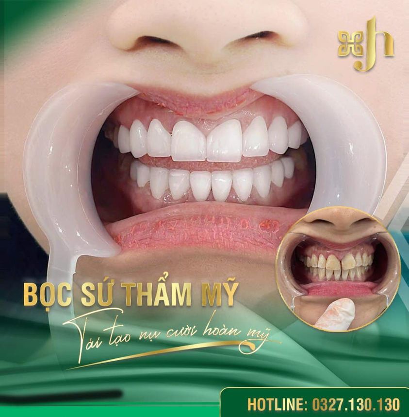 Răng sứ thẩm mỹ 