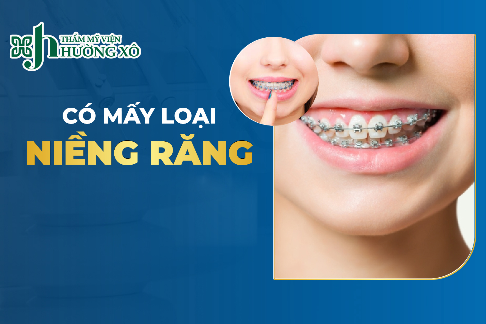 Niềng răng thẩm mỹ