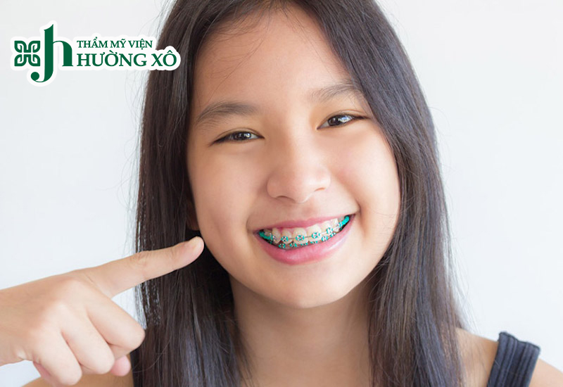 Niềng răng thẩm mỹ