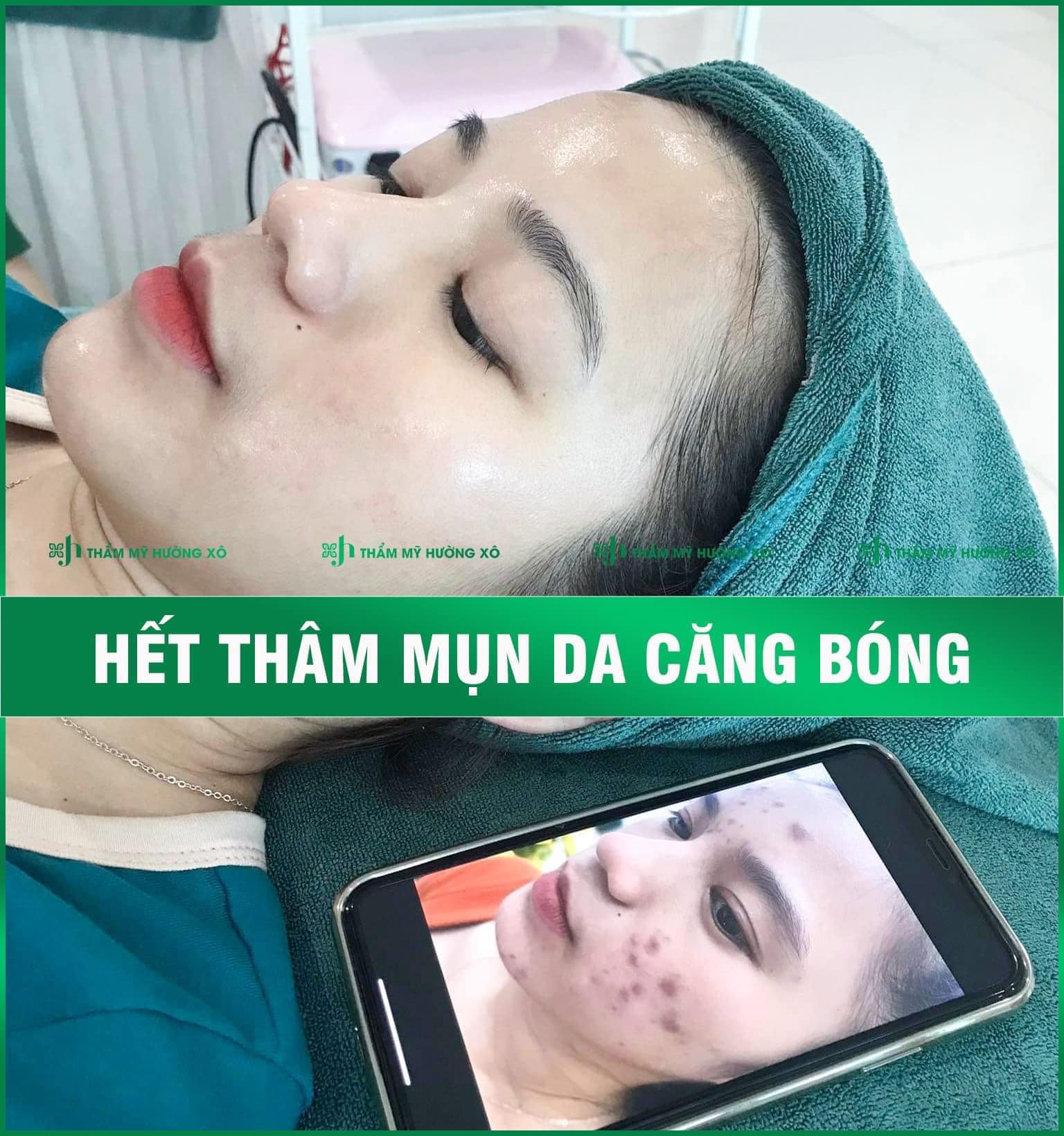 Trị thâm mụn