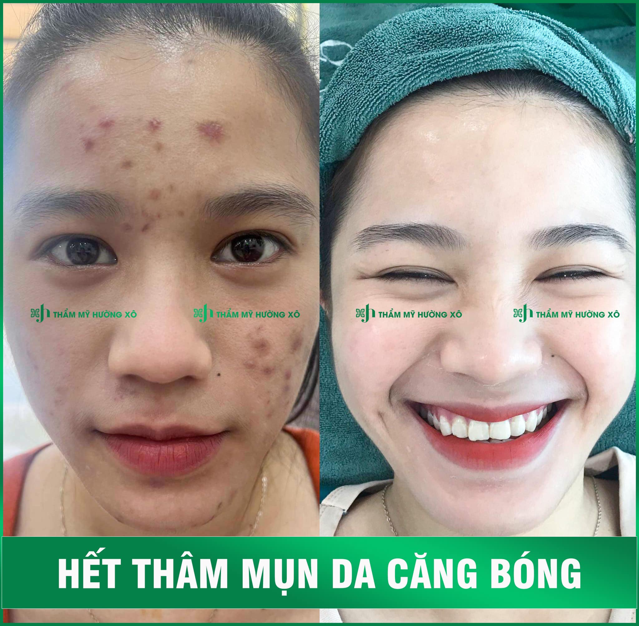 Trị thâm mụn