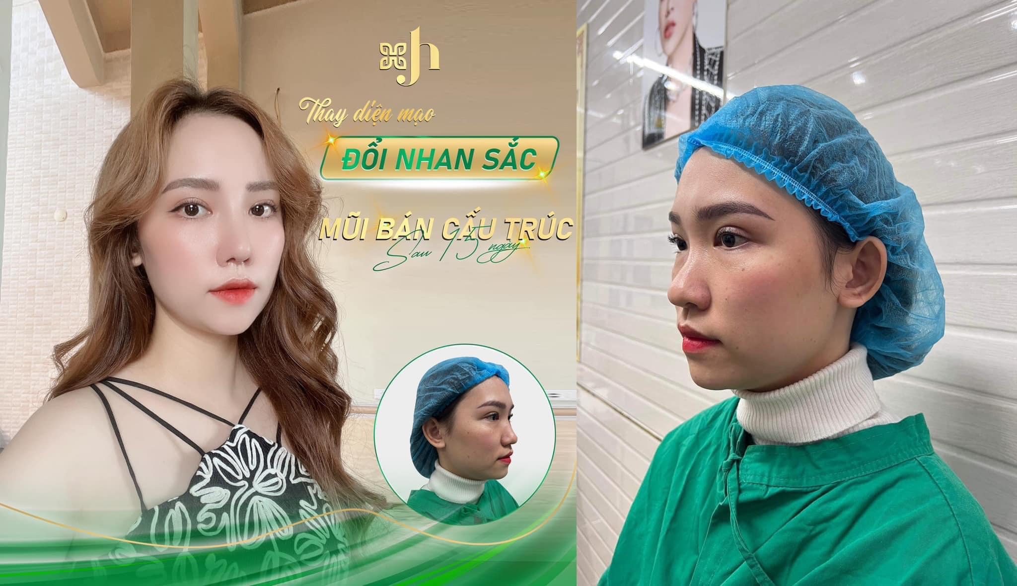 Nâng mũi bán cấu trúc