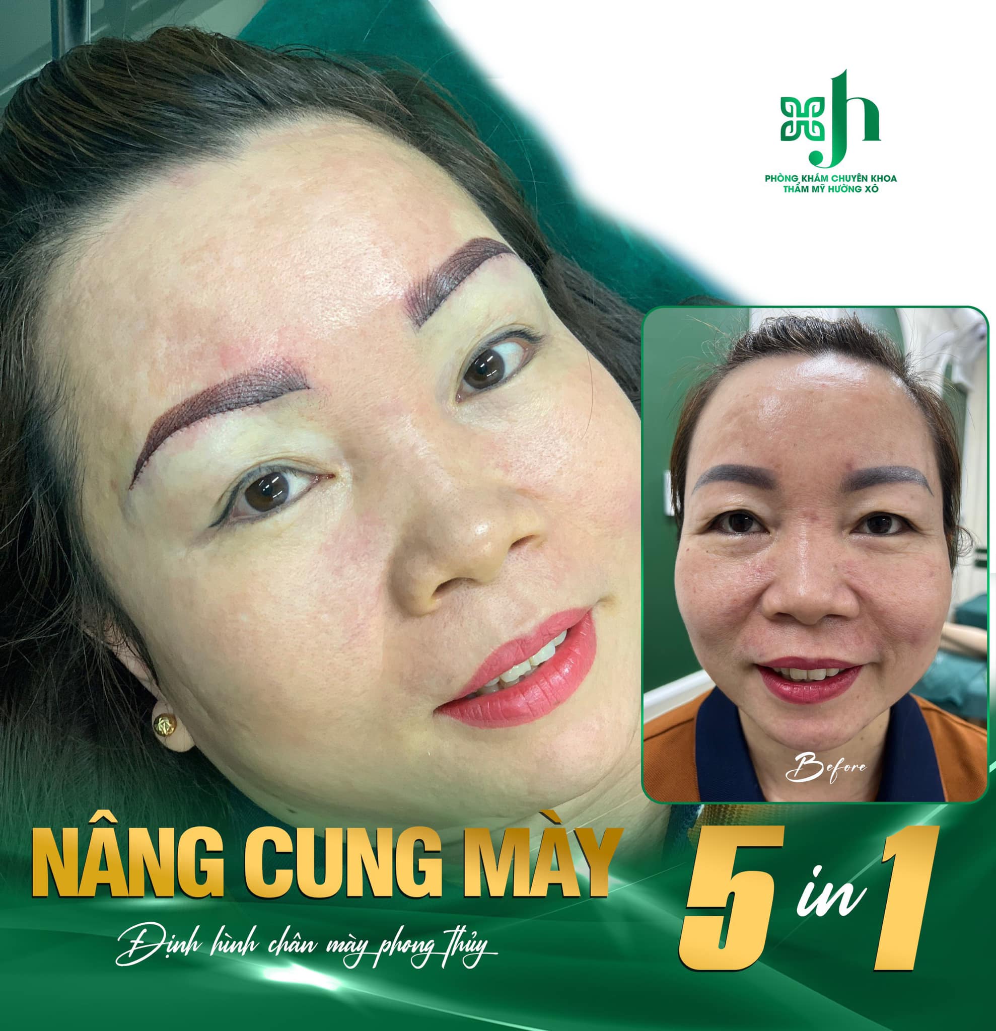 Nâng cung chân mày