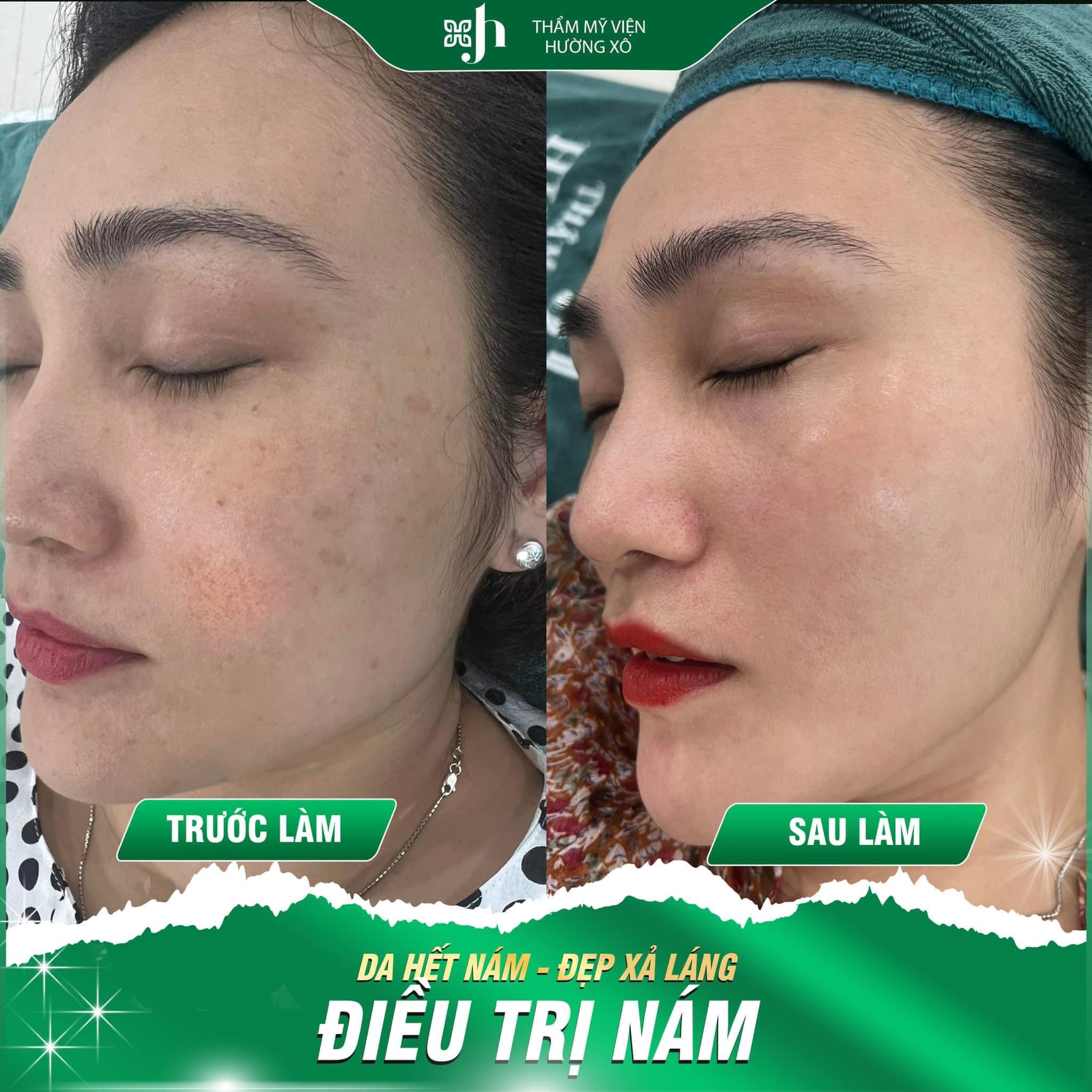 Điều trị nám da