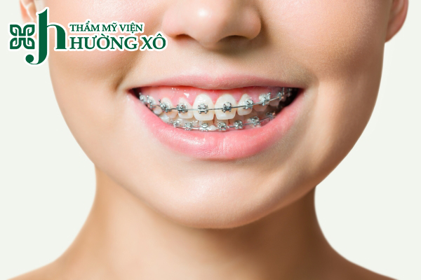 Niềng răng thẩm mỹ