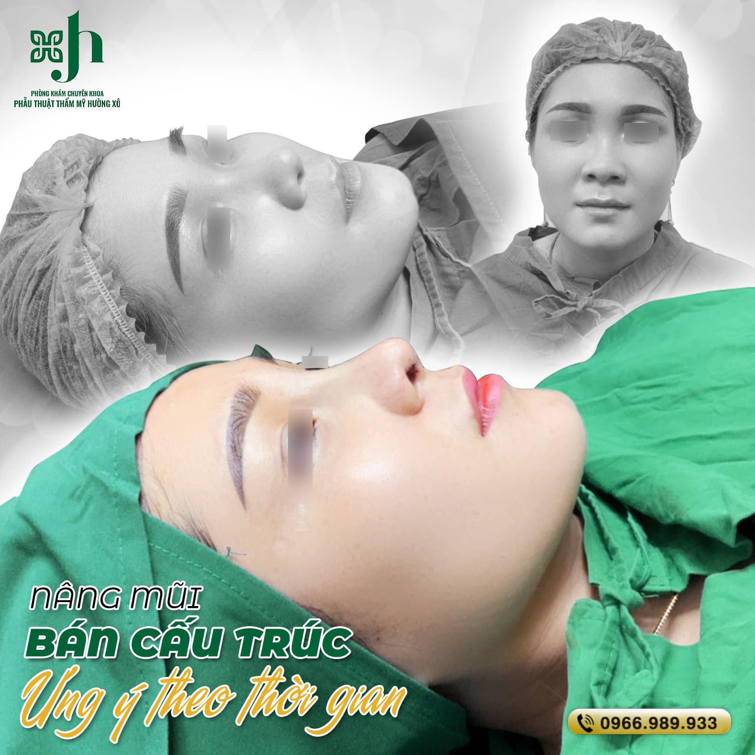 Nâng mũi bán cấu trúc