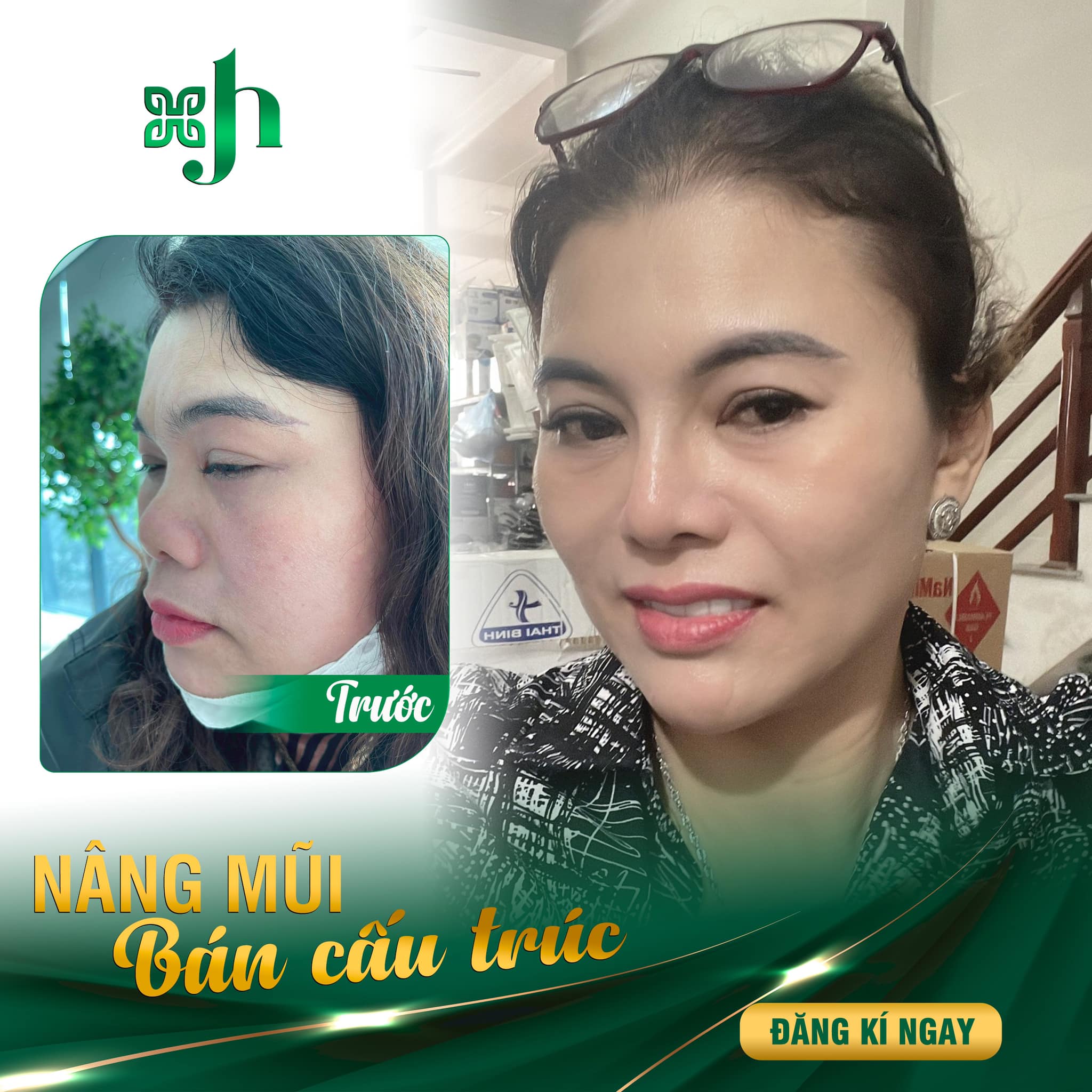 Nâng mũi bán cấu trúc