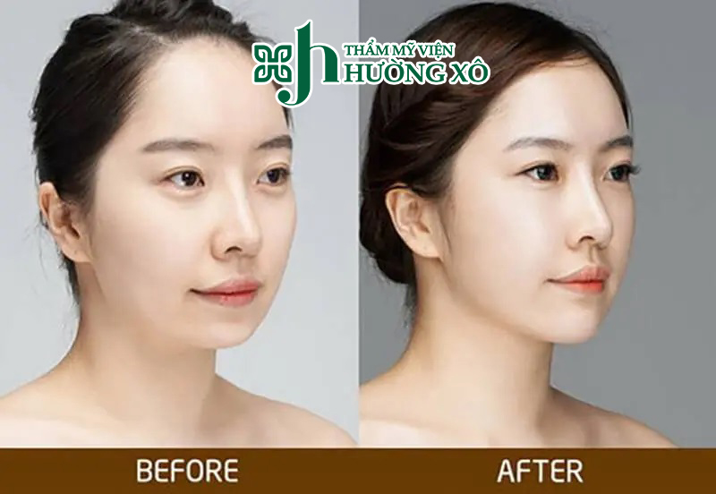 Dịch vụ độn cằm