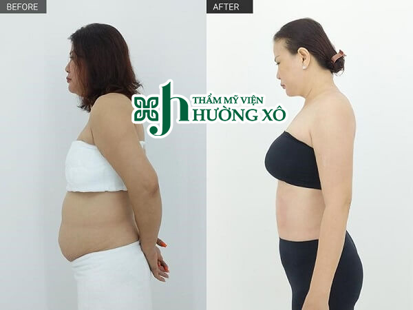 Giảm béo Contri Lipo