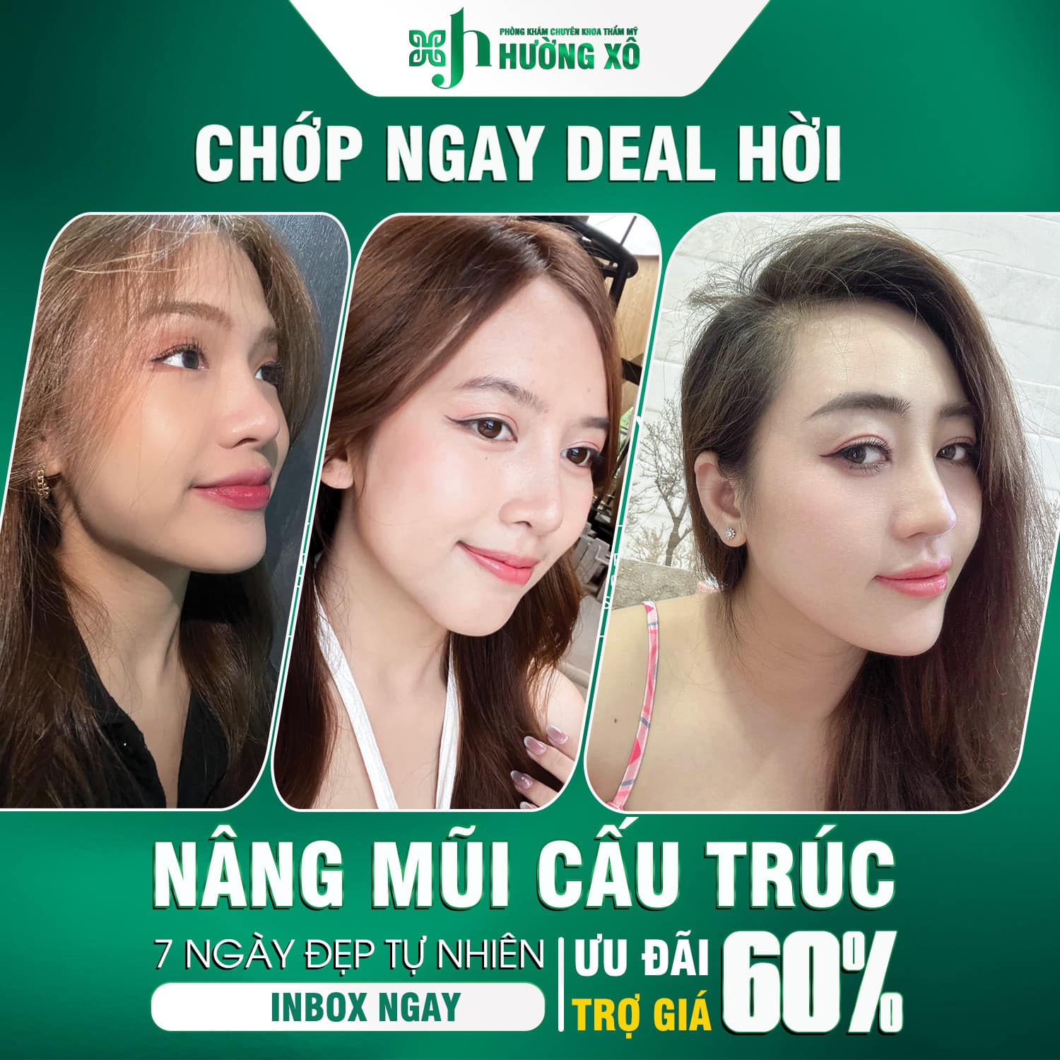 Nâng mũi cấu trúc