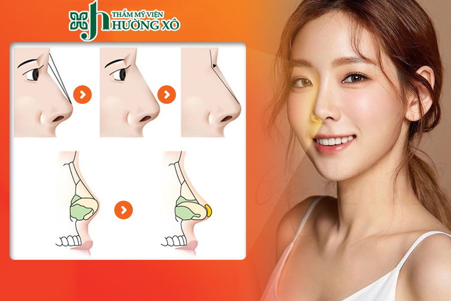 Nâng mũi bọc sụn