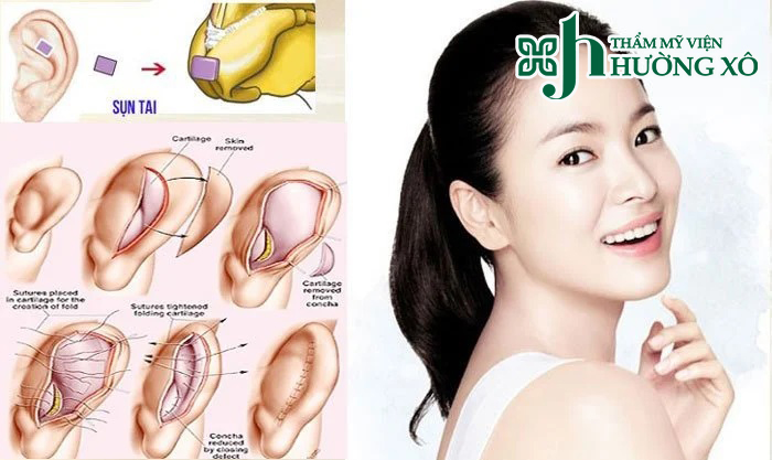 Nâng mũi bọc sụn