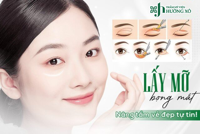 Lấy mỡ bọng mắt