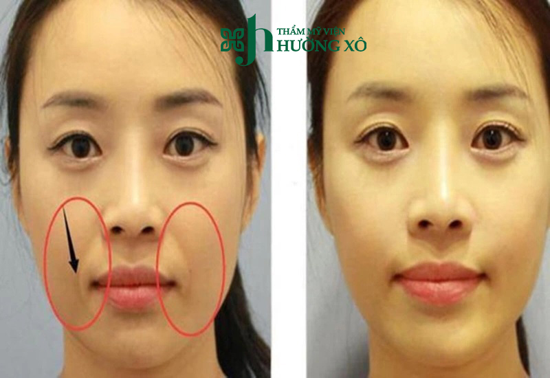 Độn rãnh cười