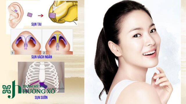 Nâng mũi cấu trúc