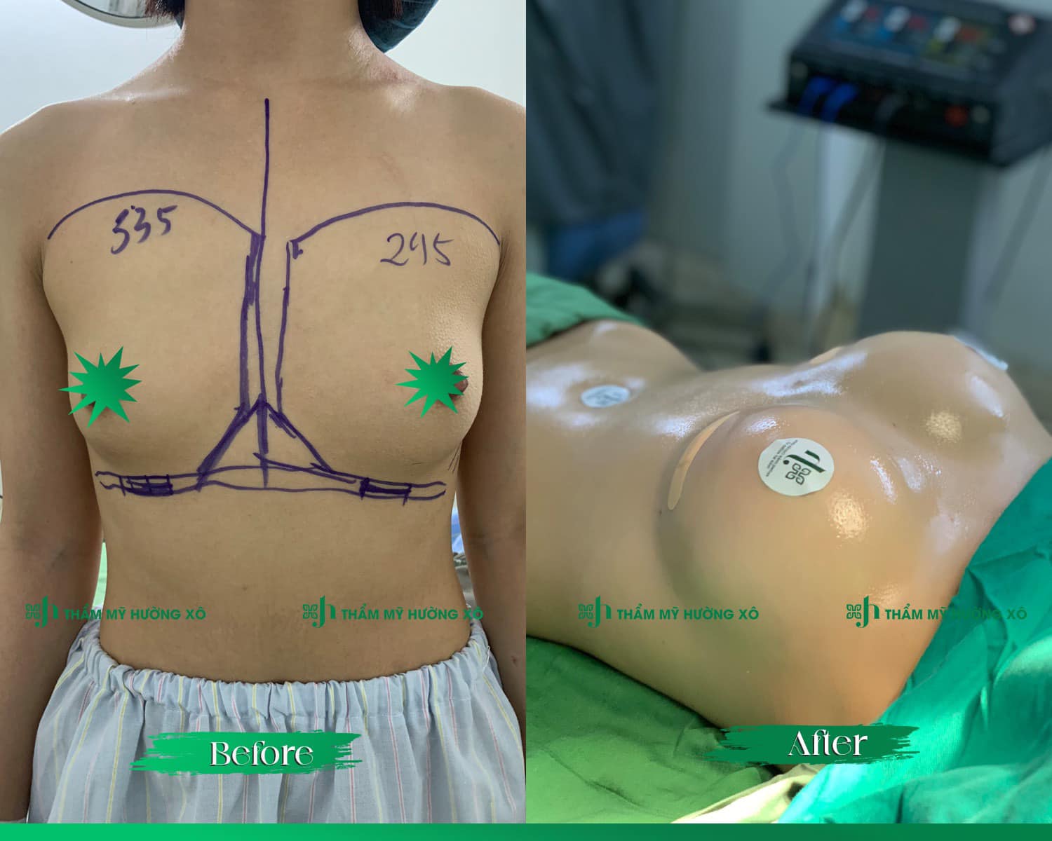 Nâng ngực không chạm