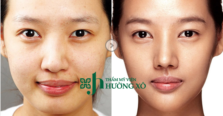 Độn rãnh cười