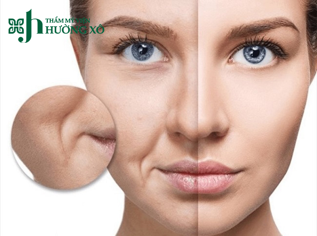 Độn rãnh cười