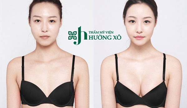 Nâng ngực uy tín