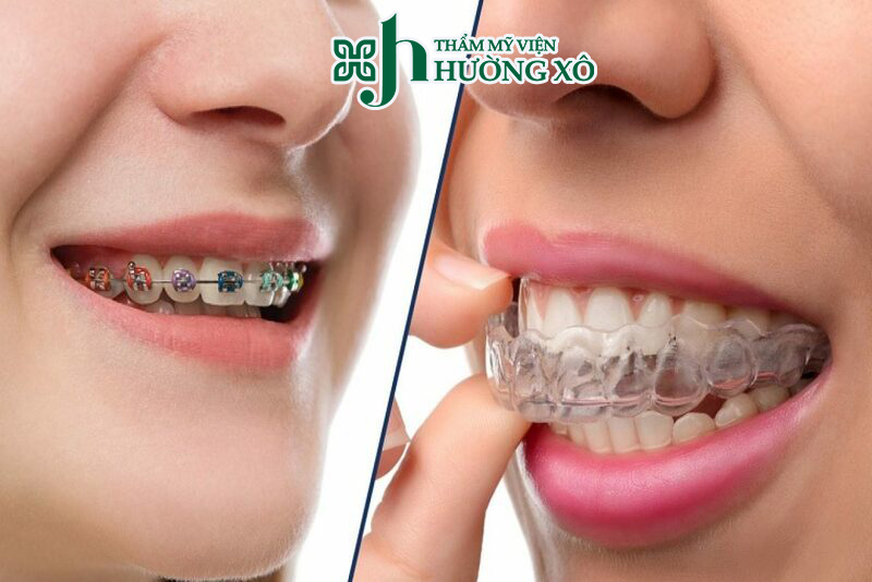 Niềng răng thẩm mỹ