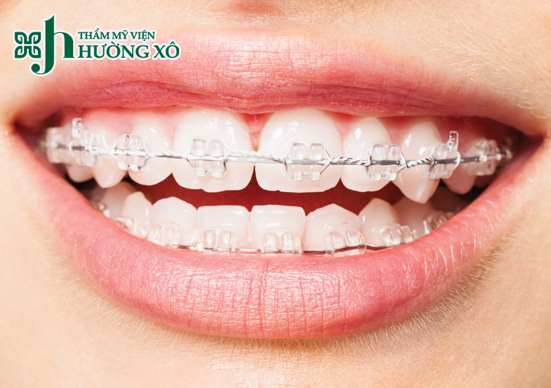 Niềng răng thẩm mỹ