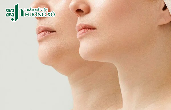 Tiêm tan nọng cằm