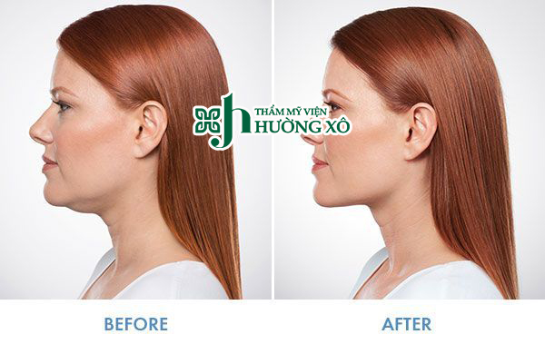 Tiêm tan nọng cằm