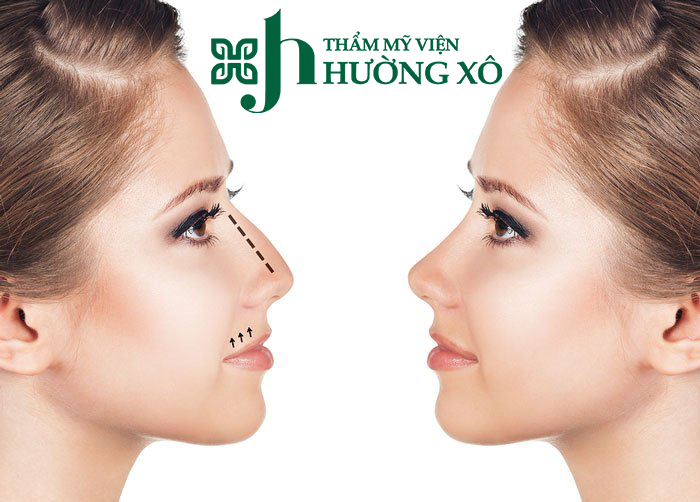 Mài gồ xương mũi