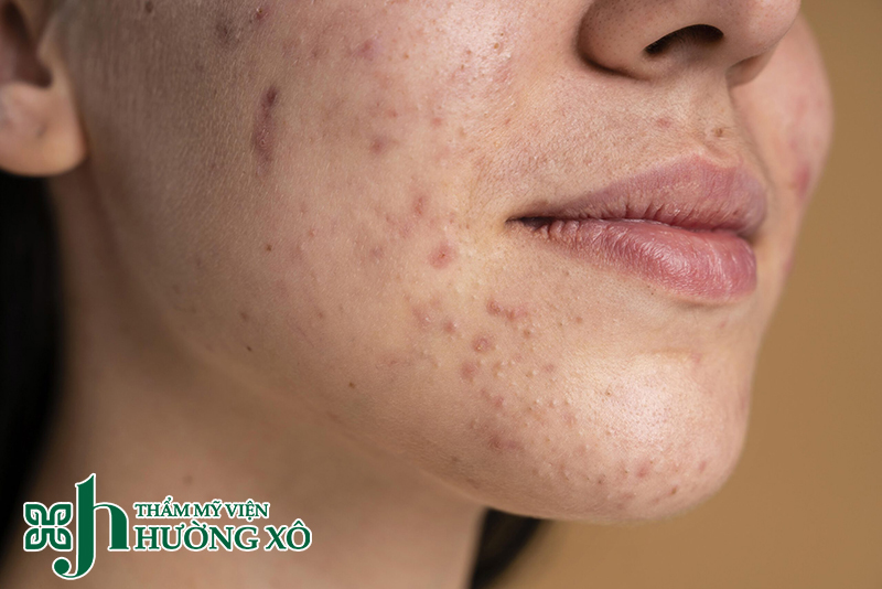 Điều trị thâm mụn