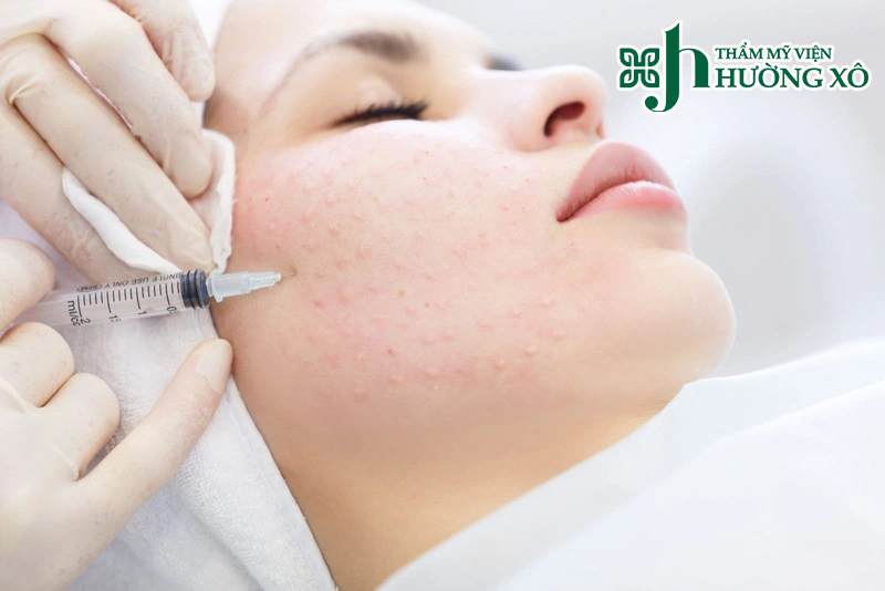 Tiêm meso căng bóng da