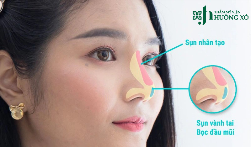 Nâng mũi bọc sụn