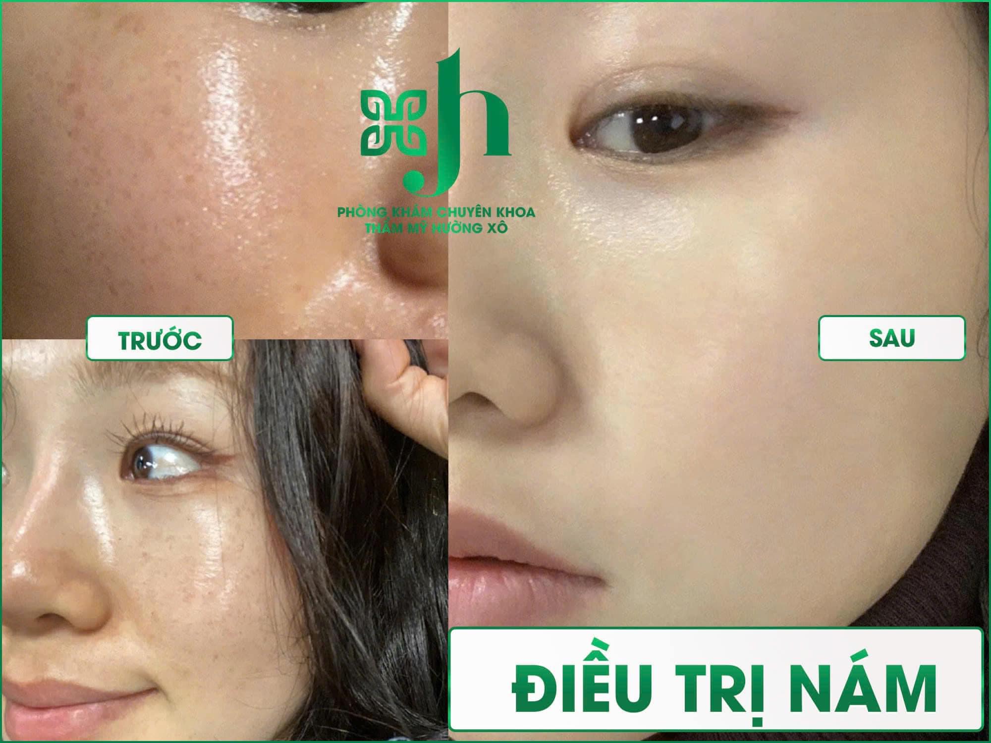 Điều trị nám