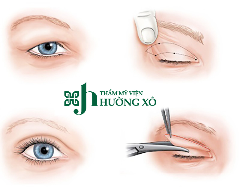 Lấy mỡ mí mắt trên